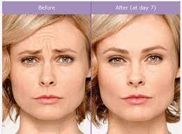 Possibilities which come with Botox injections post thumbnail image