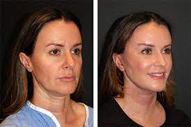Enhance Your Facial Features with Mini Facelift: A Subtle Transformation post thumbnail image