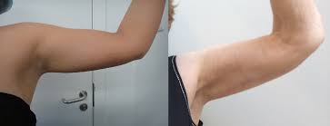Arm Liposuction: Enhancing Your Upper Body Contours post thumbnail image