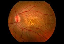 Basic Steps To Discover Age group-relevant Macula Weakening Druggist post thumbnail image