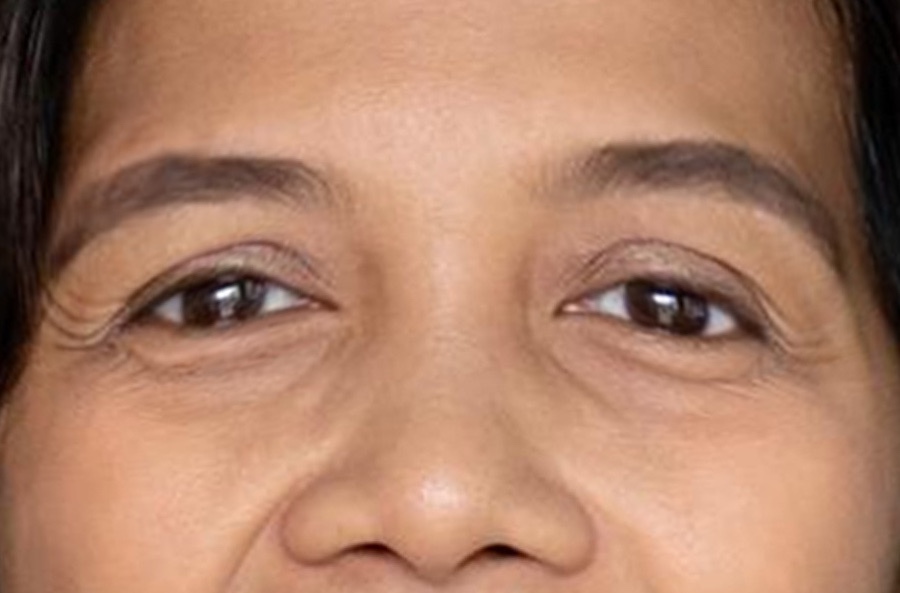 Just How Long Do Beneath Eye Fillers Last? post thumbnail image
