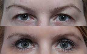 Santa Barbara’s Top Eye lid Surgery: Modifying The Way You Look post thumbnail image