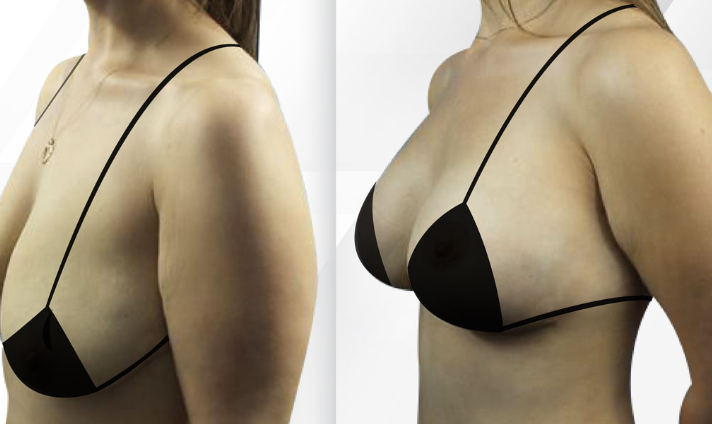 Unveiling Miami’s Foremost Hub for Exceptional Breast Implants post thumbnail image