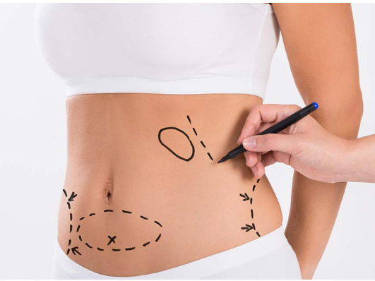 Be Bold, Be Beautiful: Your Miami Abdominoplasty Journey Begins post thumbnail image