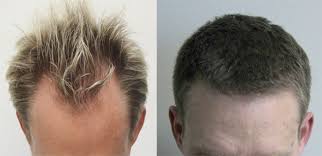 Regain Your Youthful Look with Toronto’s Best-in-Class Hair Transplant Clinics post thumbnail image